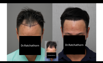 Dr.Ratchathorn Panchaprateep (Absolute hair clinic) 10 months after 2,620 grafts FUE - dense but natural hairline