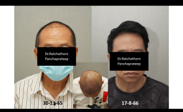 Dr.Ratchathorn Panchaprateep, MD, PhD (Absolute hair clinic): Norwood 4, 9 months after 3,530 grafts FUE