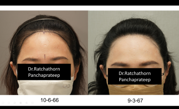 Dr.Ratchathorn Panchaprateep (Absolute hair clinic) Female hairline : 9 months after 2120 grafts Non-shaven FUE