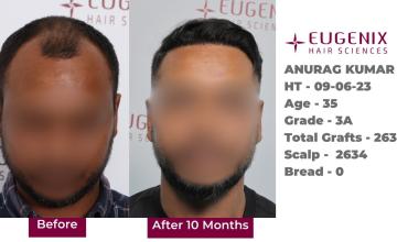 Eugenix Hair Sciences | NW 3A | 2,634 Grafts | 10 Months Hair Transplant Results| Dr. Somesh