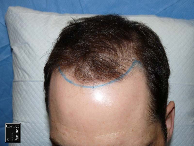 FUE Hair Transplant Results with 2,420 Grafts |
