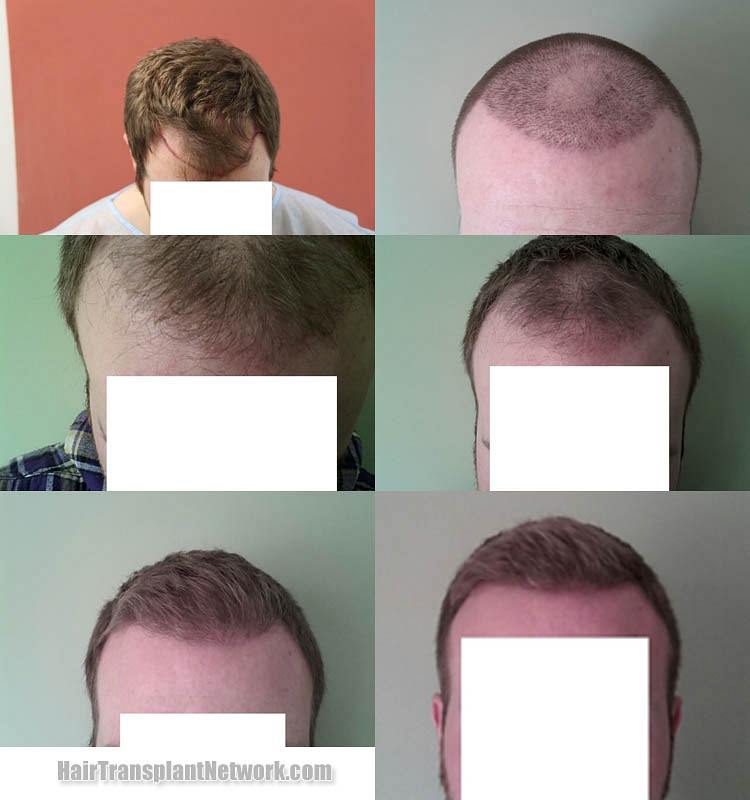 Hair transplant surgery before and after result photographs with 2830  grafts |