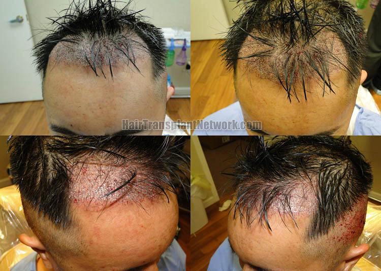 Dr John Diep Hair Restoration Surgery Before And After Result Images