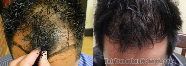 Dr John Diep Hair Restoration Surgery Before And After Result Images