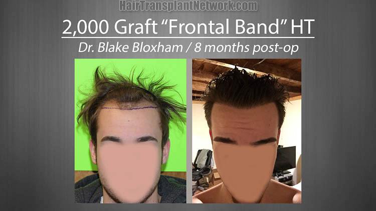 Hair Restoration surgery results with 2000 grafts via the FUT technique |