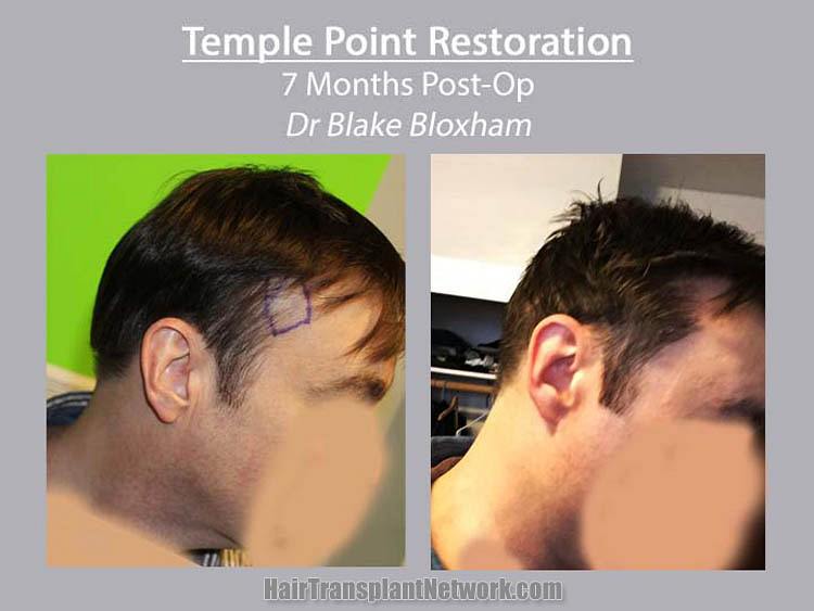 Hair transplant surgery before and after result images Temple Points |