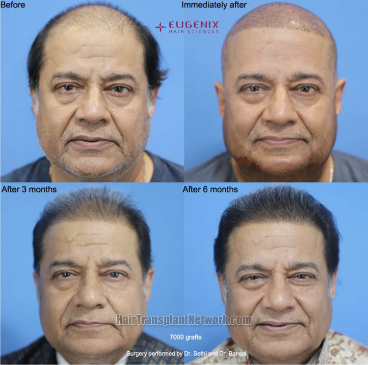 Hair transplant procedure before and after result photos with 7000 grafts |