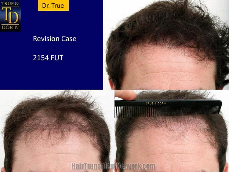 Dr. Robert True Hair transplant surgery repair before and after images