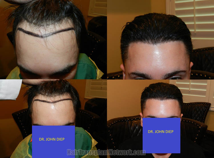 Dr John Diep Hair Transplant Procedure Before And After Result Photos With 2364 Grafts 9007