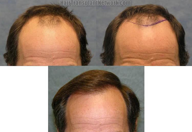 Dr. Robert M. Bernstein Hair Tramsplant patient Norwood Class 5A, 3249
