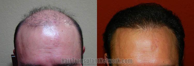 Dr John Diep Surgical Hair Restoration Before And After Pictures Withh