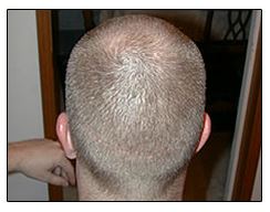 Donor area 2 months after hair transplant surgery