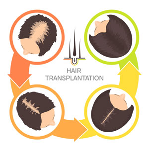Before and After of Hair Transplant Success for Female Hair Loss Hair Transplant Network