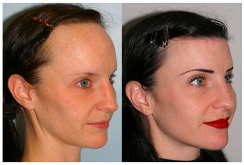 Womens Hair Loss Treatment to Lower Hairlines Hair Transplant Network