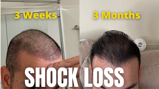 Hair Transplant Growth Stages (Ugly Duckling, Terrible Threes, Growth  Phase, and Maturation)