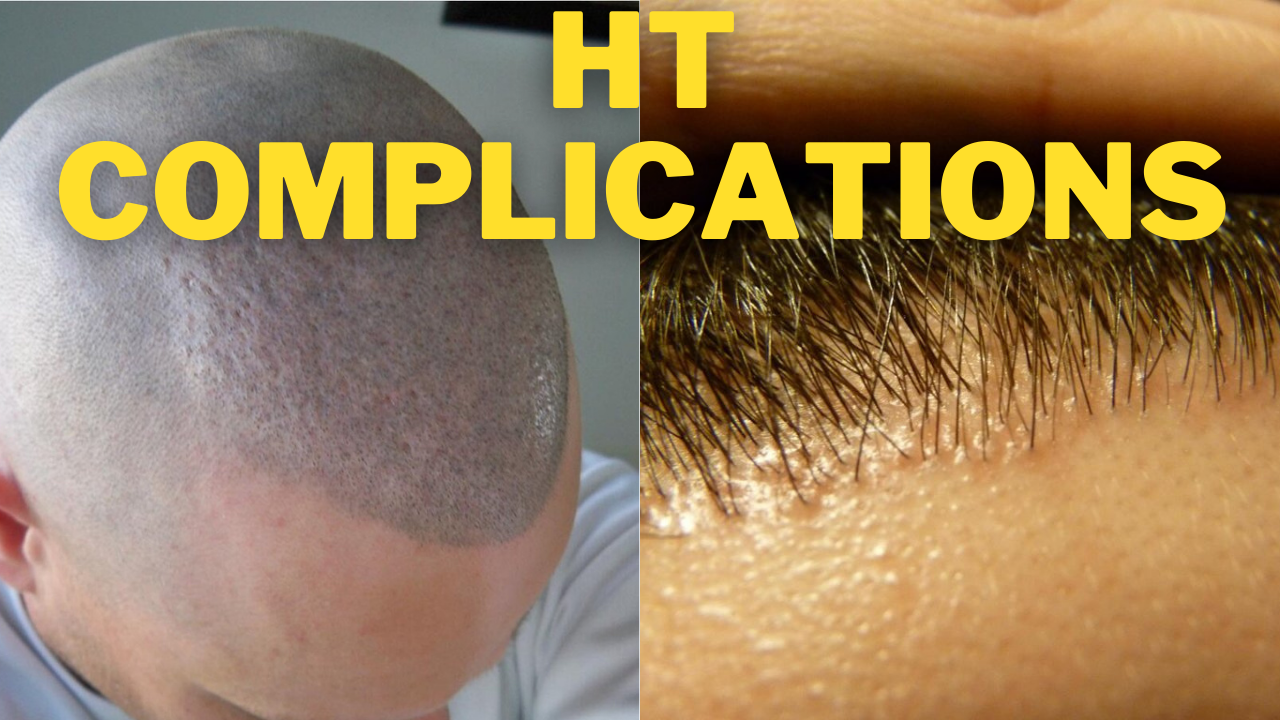 hair transplant complications