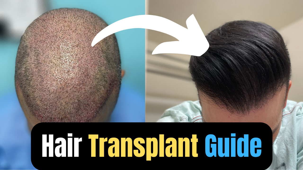 ultimate hair transplant guide