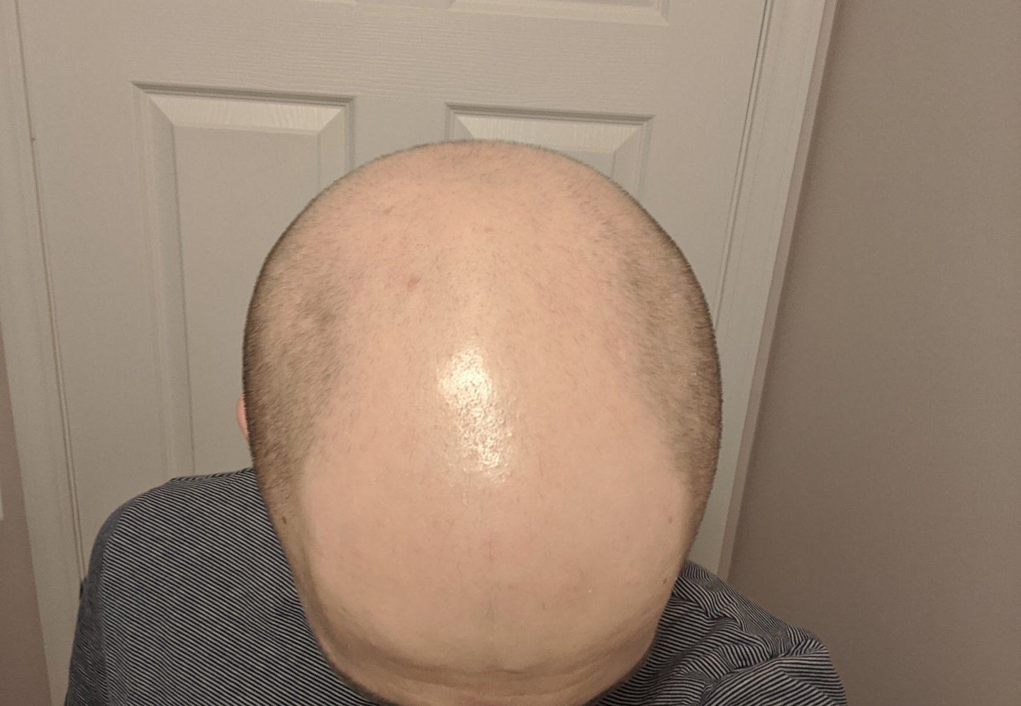 male pattern baldness