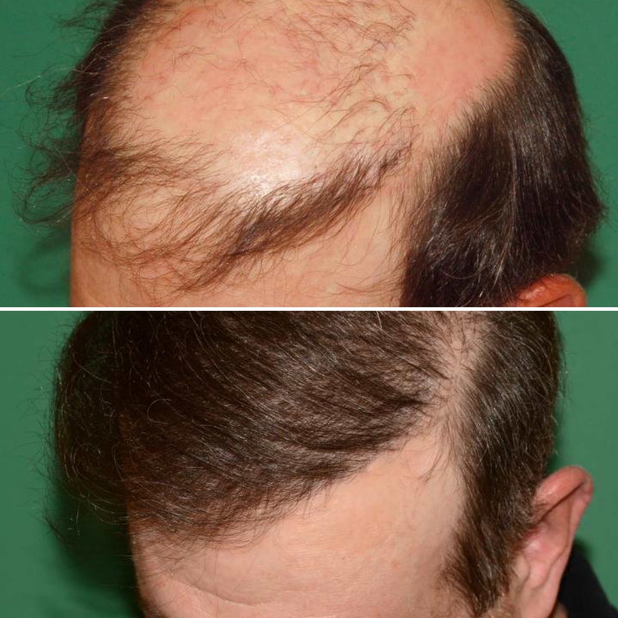 Before and after hair transplant repair
