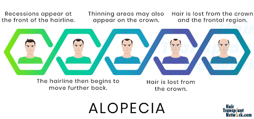 How Alopecia Affects Hair Growth – Hair Transplant Network