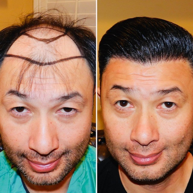 Hair Transplant Results