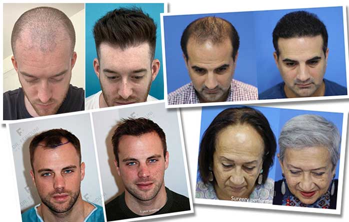 Patient before and after hair transplant