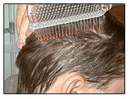 Sutures removed after hair transplant