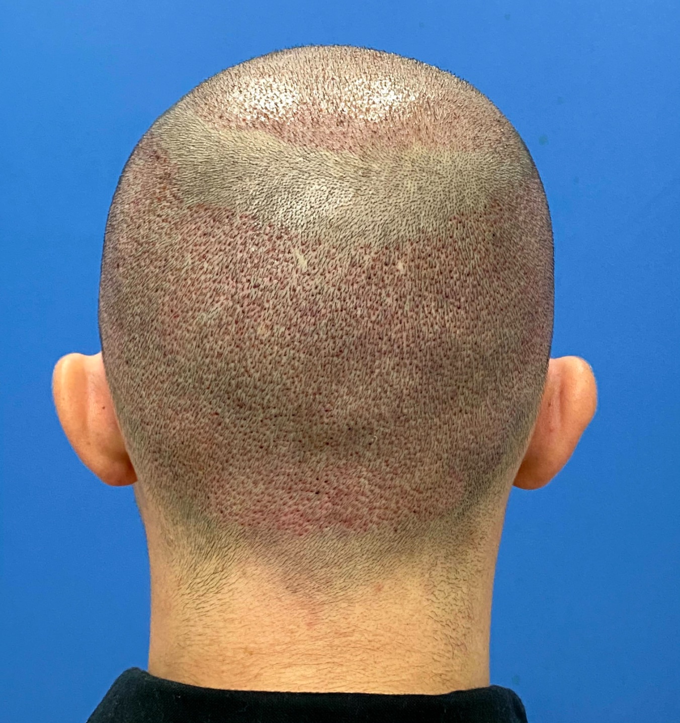 FUE hair transplant