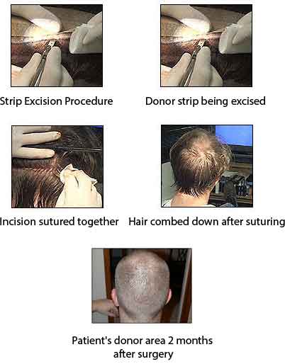 hair transplant donor strip removal