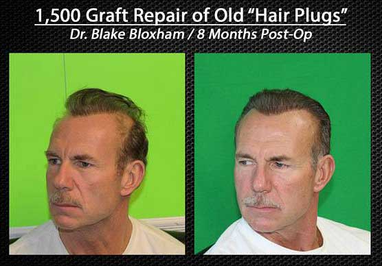 Hair transplant repair