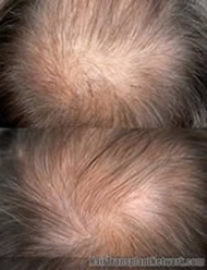 ACell for Hair Restoration And Hair Duplication