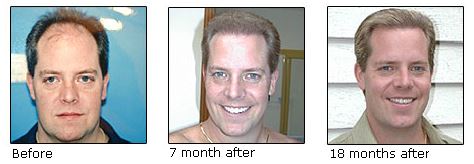 Progress of hair transplant