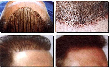 Female Pattern Baldness