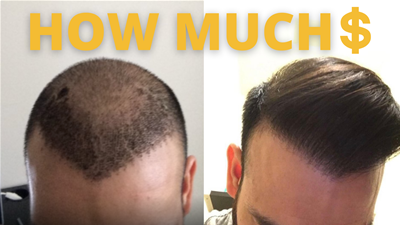 How Much Does A Hair Transplant Cost?