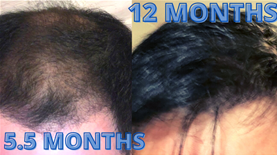 What Are The Reasons For Hair Transplant Slow Growth