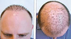 Hair Transplant Consultation London cost, What can I expect at my hair  transplant consultation