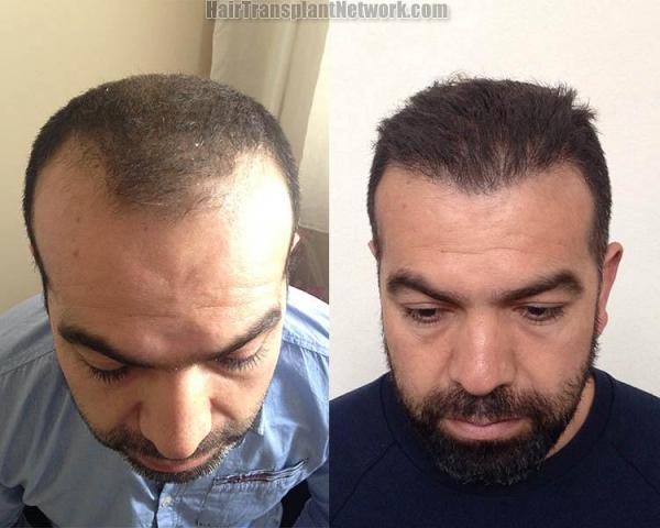Front view - Before and after hair transplant surgery result images