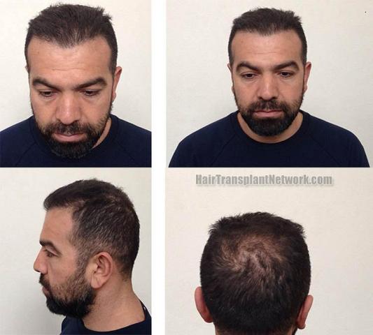 Hair restoration surgery before and after photographs