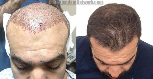 Hair restoration procedure immediate postoperative and after pictures