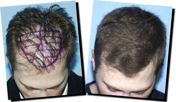 Hair restoration procedure results