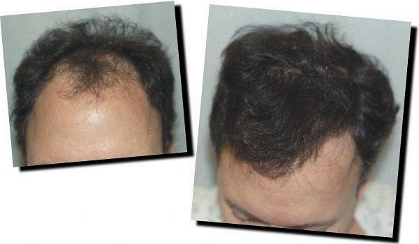 Hair restoration procedure results