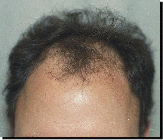 Hair restoration procedure results