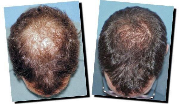 Hair restoration procedure results