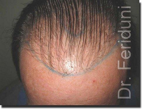 Hair restoration procedure results