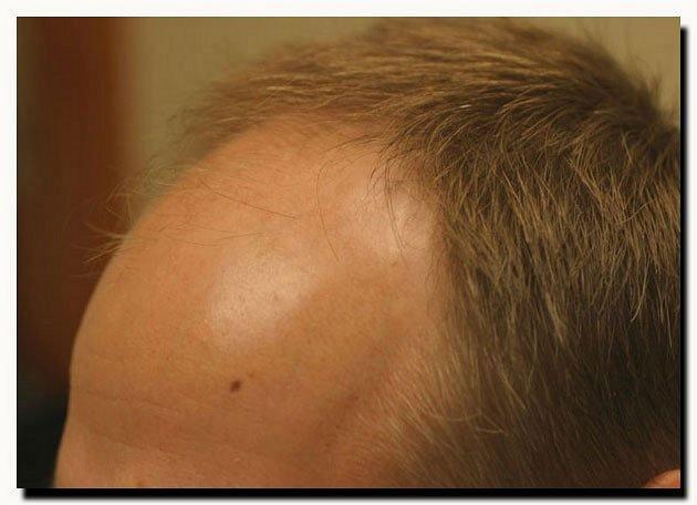 Hair restoration procedure results