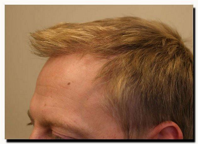 Hair restoration procedure results