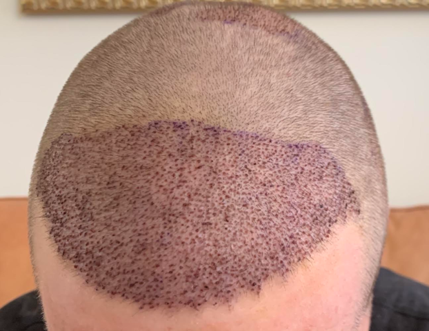 Graft placement in hairline, midscalp and crown