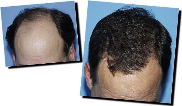 Hair restoration procedure results