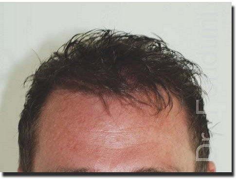 Hair restoration procedure results