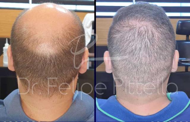 Back of Patient before and after FUE surgery